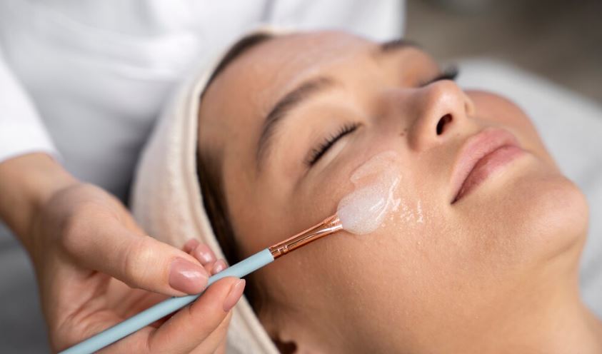 chemical peel for acne treatment
